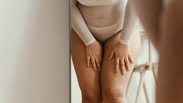 Vrouw met cellulite op de benen
